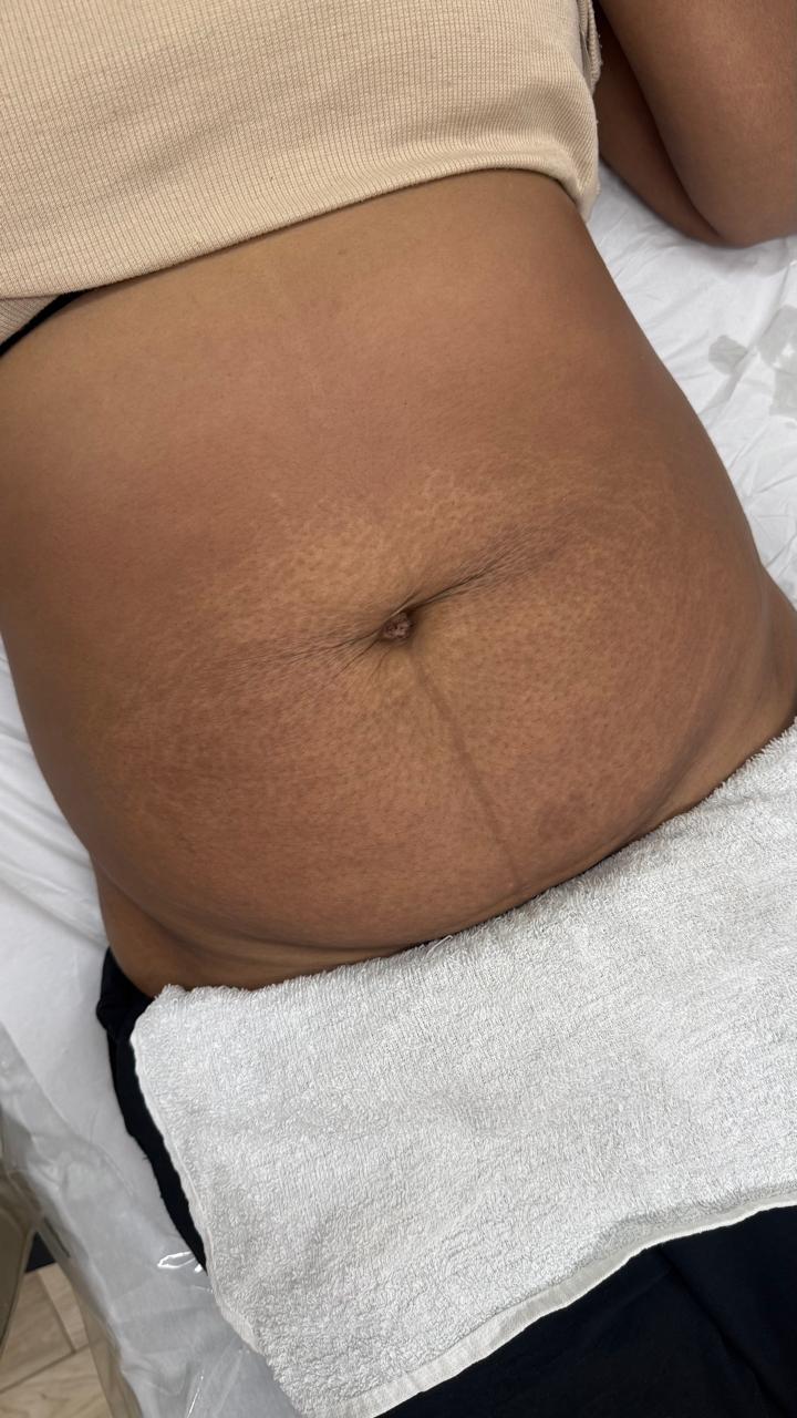 Depois do tratamento 1