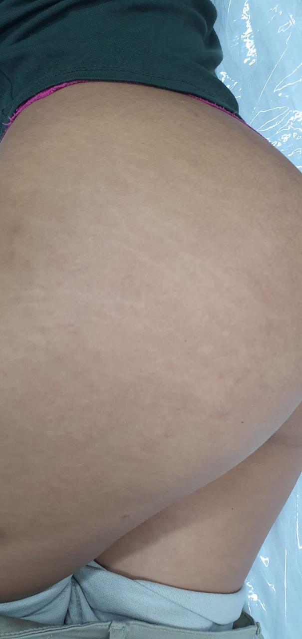 Depois do tratamento 3